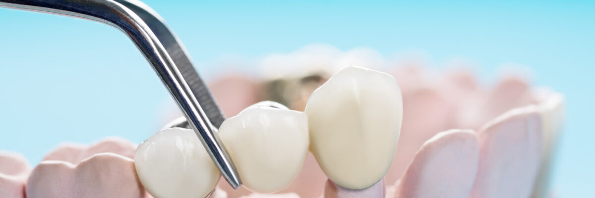 Closeup / Prosthodontics or Prosthetic / Teeth crown and bridge implant dentistry equipment and model express fix restoration.