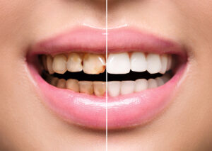 before and after dental treatment, Teeth Whitening